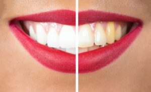 Understanding your treatment options can guide you toward the best solution for your unique tooth discoloration needs.